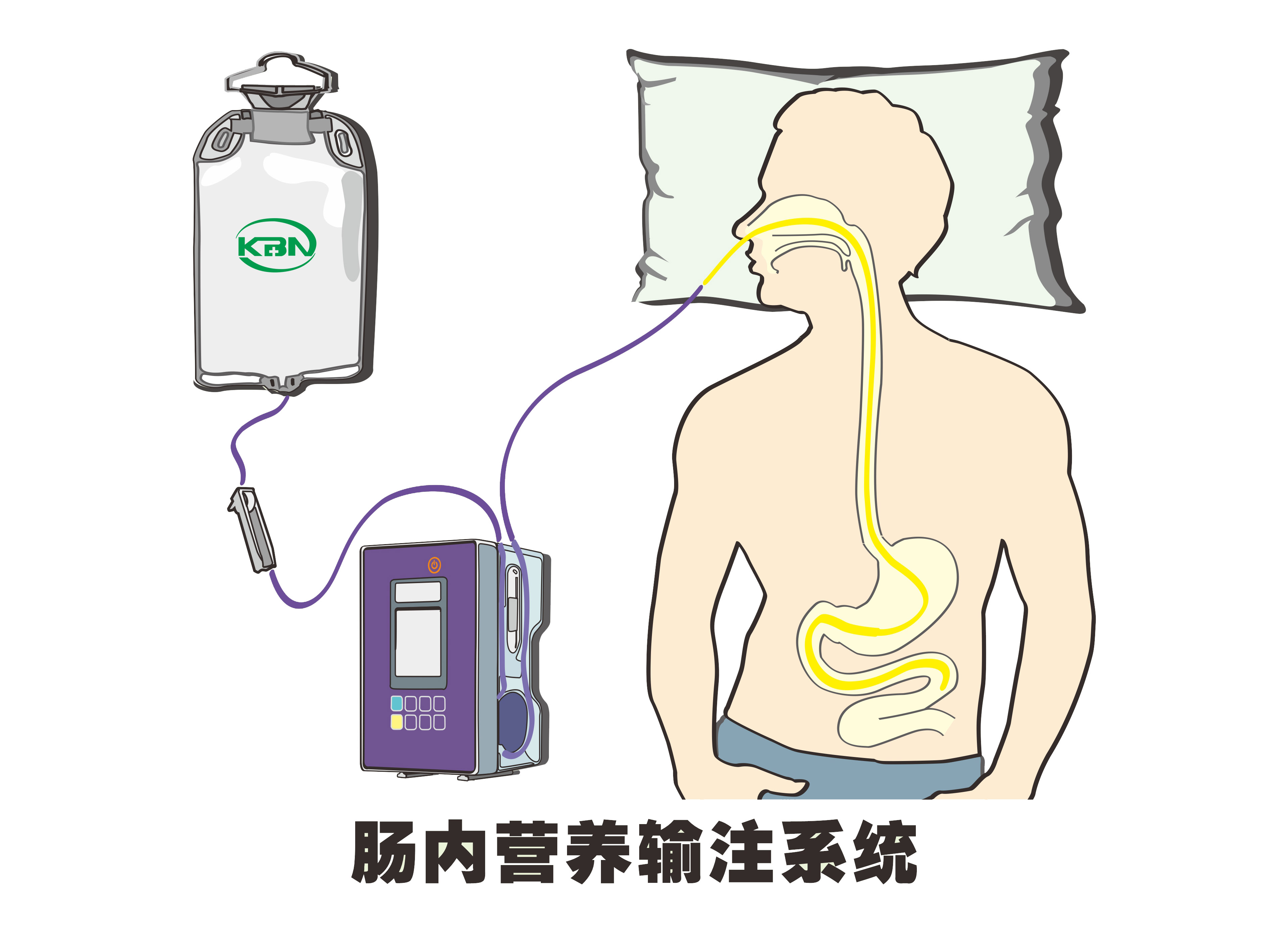 腸內(nèi)營(yíng)養(yǎng)輸注系統(tǒng)